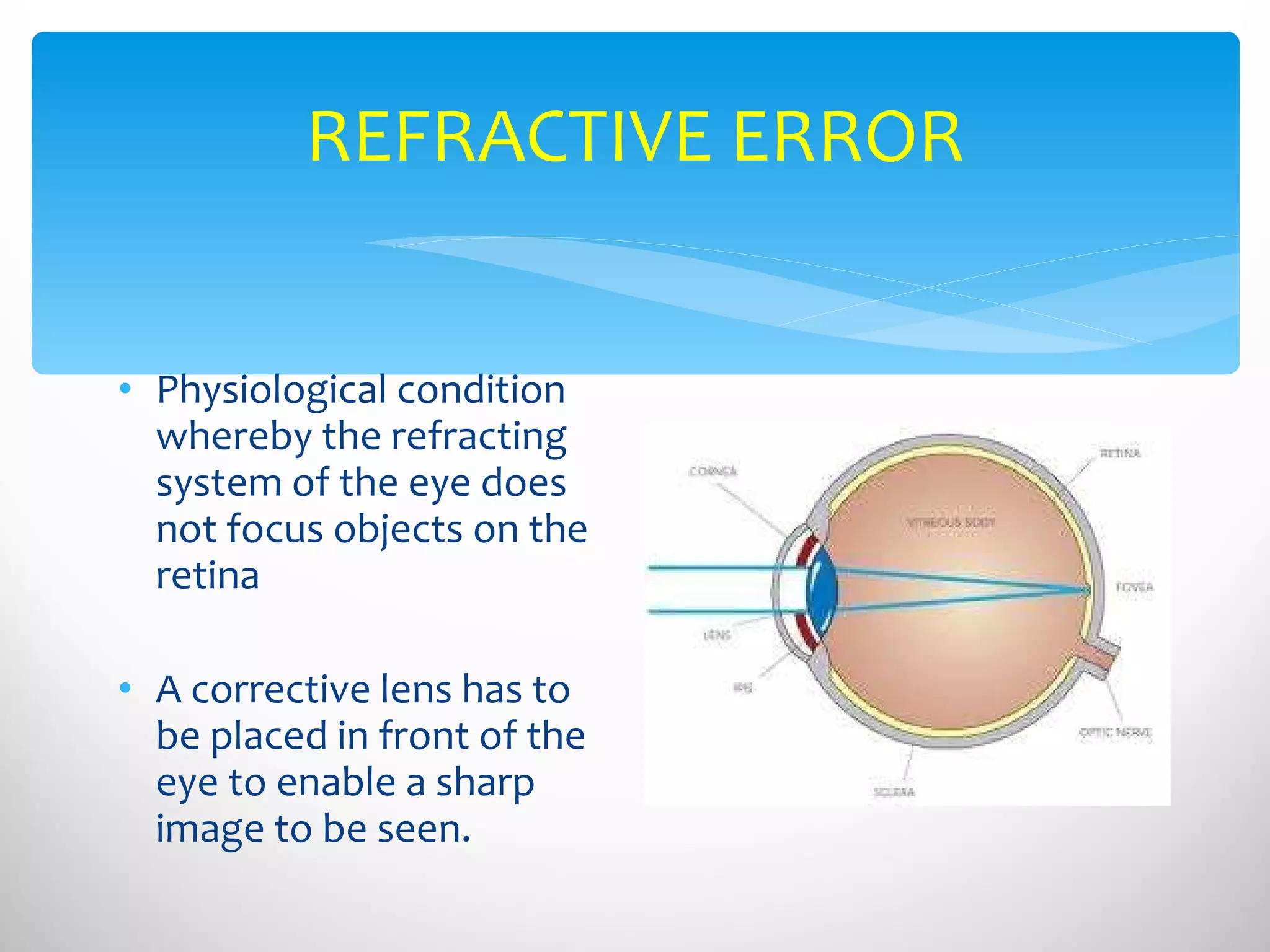 REFRACTIVE ERROR Physiological condition whereby the refracting system of the eye does not focus objects on the retina  A corrective lens has to be placed in front of the eye to enable a sharp image to be seen.  