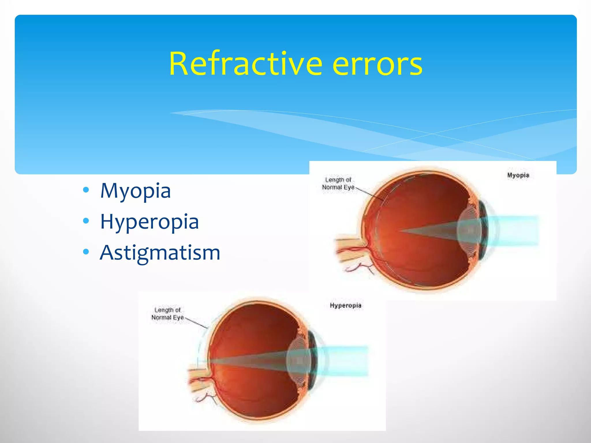 Myopia Hyperopia Astigmatism Refractive errors 