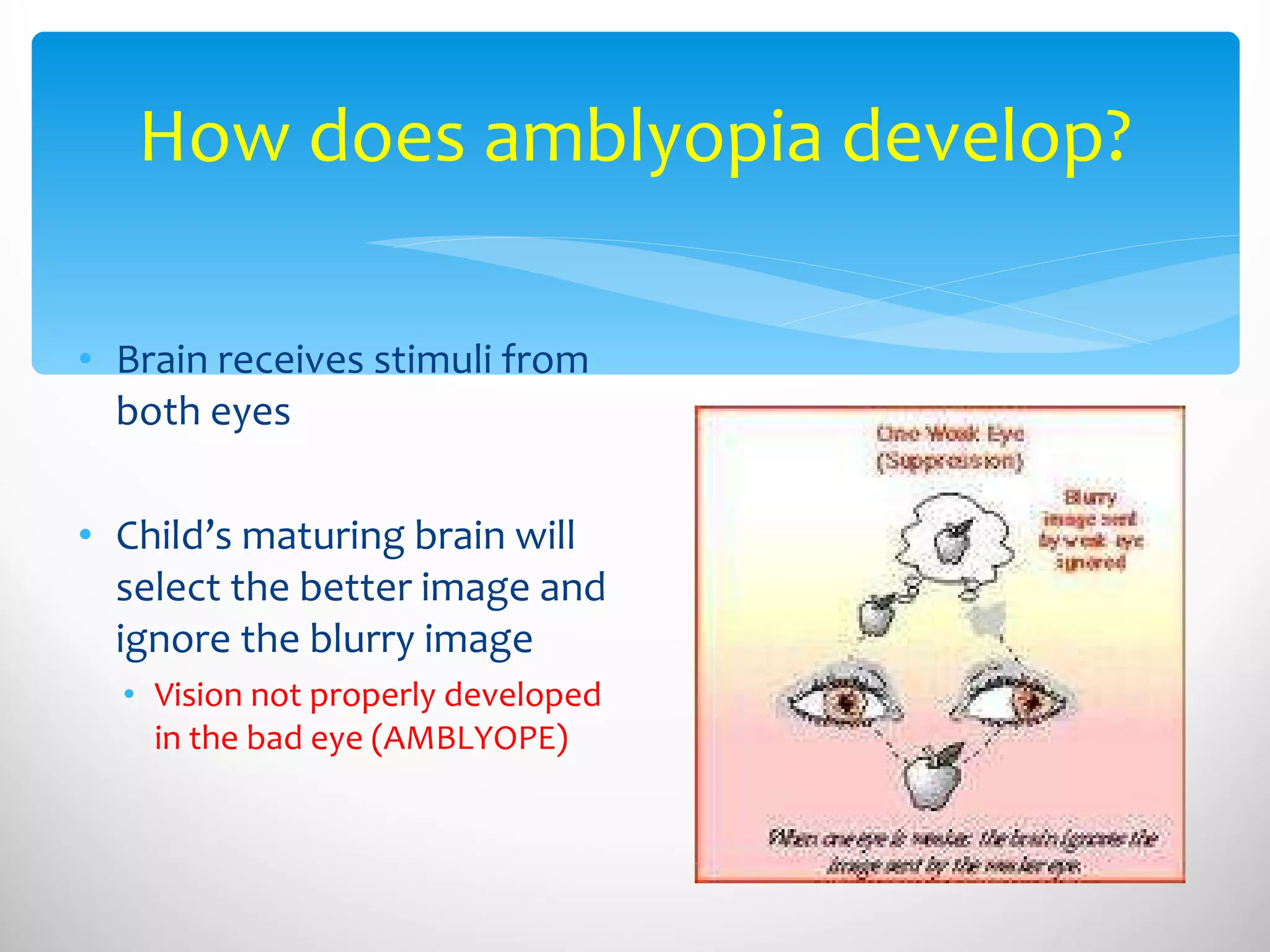 How does amblyopia develop? Brain receives stimuli from both eyes Child’s maturing brain will select the better image and ignore the blurry image Vision not properly developed in the bad eye (AMBLYOPE) 
