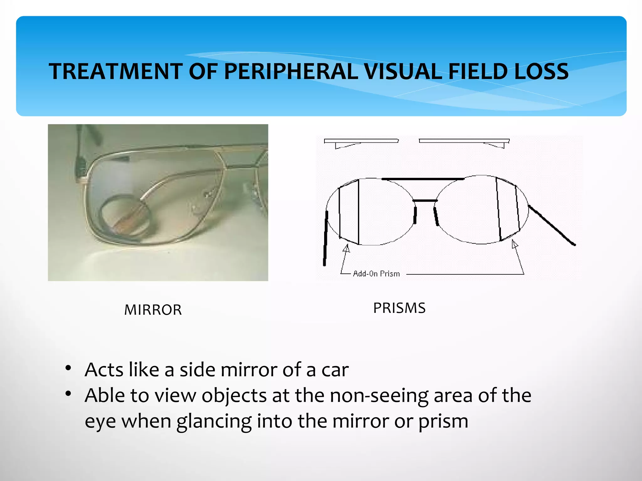 TREATMENT OF PERIPHERAL VISUAL FIELD LOSS MIRROR PRISMS Acts like a side mirror of a car Able to view objects at the non-seeing area of the eye when glancing into the mirror or prism 