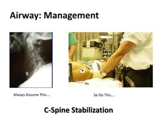 Airway: Management
Always Assume This…. So Do This….
C-Spine Stabilization
 