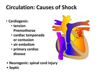 Circulation: Causes of Shock
• Neurogenic: spinal cord injury
• Septic
• Cardiogenic:
• tension
Pnemothorax
• cardiac tamponade
or contusion
• air embolism
• primary cardiac
disease
 