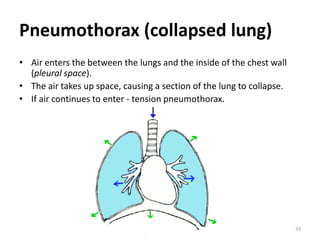 Pneumothorax (collapsed lung)
• Air enters the between the lungs and the inside of the chest wall
(pleural space).
• The air takes up space, causing a section of the lung to collapse.
• If air continues to enter - tension pneumothorax.
33
 