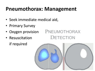 35
Pneumothorax: Management
• Seek immediate medical aid,
• Primary Survey
• Oxygen provision
• Resuscitation
if required
 