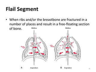 36
Flail Segment
• When ribs and/or the breastbone are fractured in a
number of places and result in a free-floating section
of bone.
 