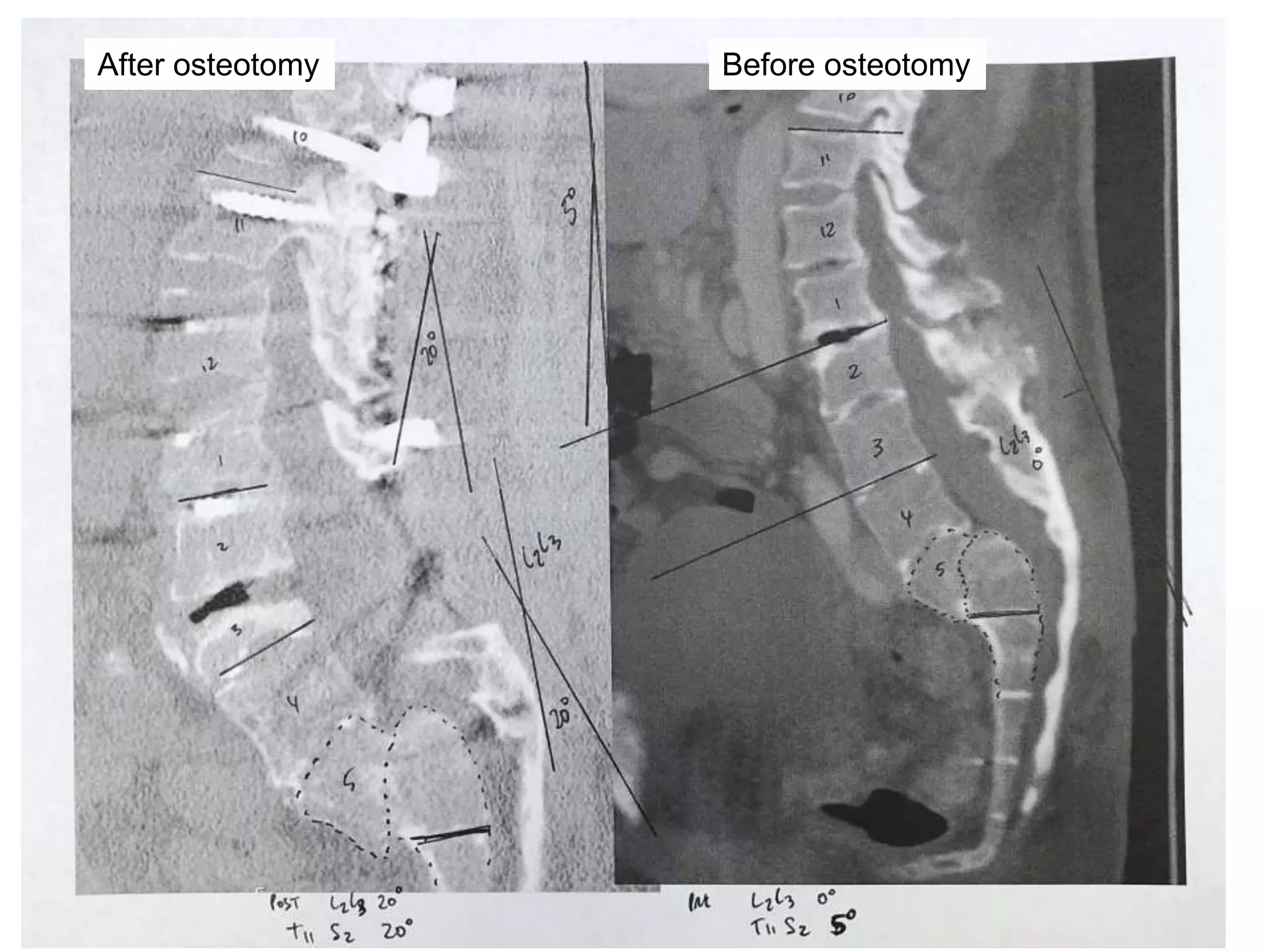 Nonunion PSO pedicle subtraction osteotomy | PPTX