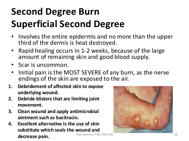 What are some good second-degree burn treatments?