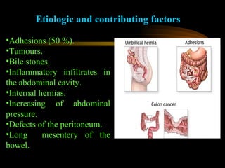 Etiologic and contributing factors Adhesions (50 %). Tumours. Bile stones. Inflammatory infiltrates in the abdominal cavity. Internal hernias. Increasing of abdominal pressure. Defects of the peritoneum. Long  mesentery of the bowel. 