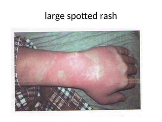 Tb Rashes lecture INTESTINAL YERSINIASIS AND PSEUDOTUBERCULOSIS 2024.ppt