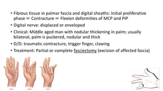 • Fibrous tissue in palmar fascia and digital sheaths: Initial proliferative
phase ☞ Contracture ☞ Flexion deformities of MCP and PIP
• Digital nerve: displaced or enveloped
• Clinical: Middle aged man with nodular thickening in palm; usually
bilateral, palm is puckered, nodular and thick
• D/D: traumatic contracture, trigger finger, clawing
• Treatment: Partial or complete fasciectomy (excision of affected fascia)
 
