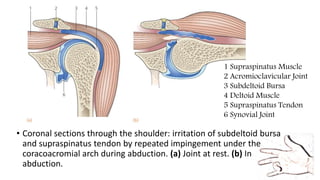 • Coronal sections through the shoulder: irritation of subdeltoid bursa
and supraspinatus tendon by repeated impingement under the
coracoacromial arch during abduction. (a) Joint at rest. (b) In
abduction.
1 Supraspinatus Muscle
2 Acromioclavicular Joint
3 Subdeltoid Bursa
4 Deltoid Muscle
5 Supraspinatus Tendon
6 Synovial Joint
 