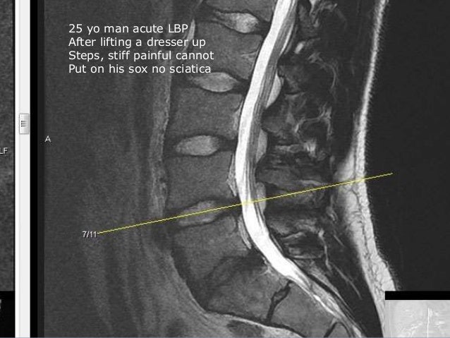 low back pain with
