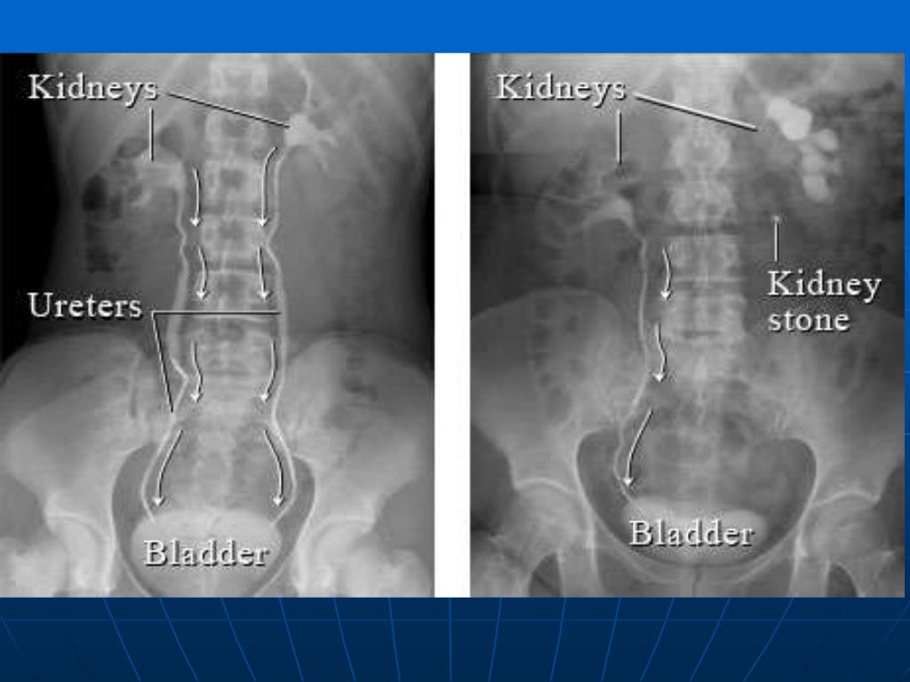 Low Back Pain with a normal xray
