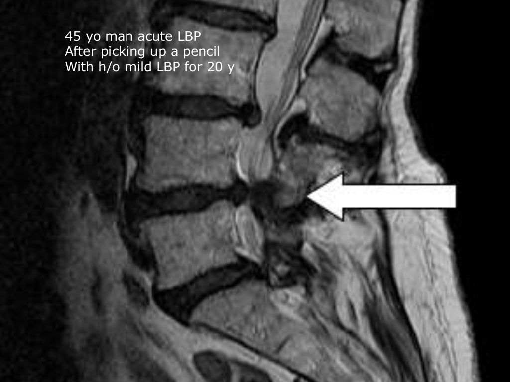 Low Back Pain with a normal xray