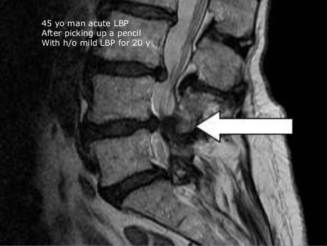 low back pain with