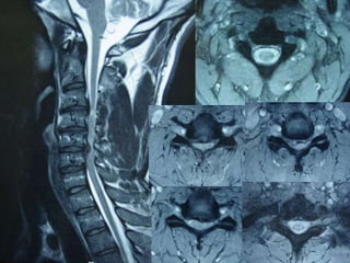 Lecture Low Back Paine with a normal xray 2021 