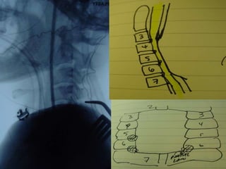 Lecture Low Back Paine with a normal xray 2021 
