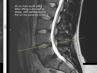 25 yo man acute LBP
After lifting a dresser up
Steps, stiff painful cannot
Put on his socks no sciatica
 