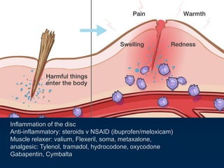 Inflammation of the disc
Anti-inflammatory: steroids v NSAID (ibuprofen/meloxicam)
Muscle relaxer: valium, Flexeril, soma, metaxalone,
analgesic: Tylenol, tramadol, hydrocodone, oxycodone
Gabapentin, Cymbalta
 