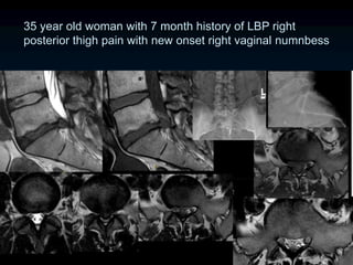 35 year old woman with 7 month history of LBP right
posterior thigh pain with new onset right vaginal numnbess
 