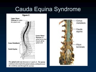 Cauda Equina Syndrome
 