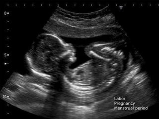 Labor
Pregnancy
Menstrual period
 