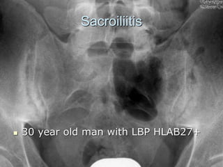 Sacroiliitis
 30 year old man with LBP HLAB27+
 