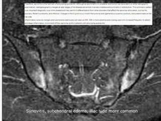 Synovitis, subchondral edema, iliac side more common
 