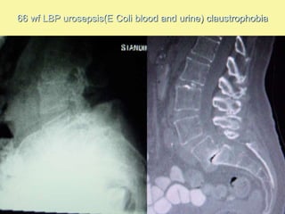 66 wf LBP urosepsis(E Coli blood and urine) claustrophobia
 