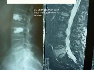 Occult Fracture
75 wm severe! LBP S/P cement 6 months ago
65 year old man with
Recurrent LBP that is
severe
 