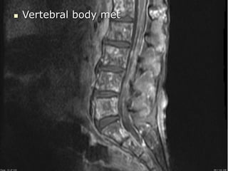 Tumor: vertebral body
 Vertebral body met
 