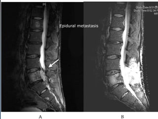 Epidural metastasis
 