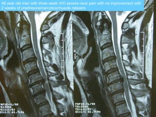 48 year old man with three week H/O severe neck pain with no improvement with
2 weeks of prednisone/narcotics/muscle relaxers
 