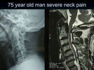 75 year old man severe neck pain
 