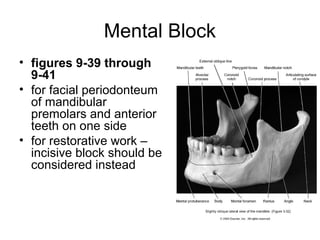 Mental Block
• figures 9-39 through
  9-41
• for facial periodonteum
  of mandibular
  premolars and anterior
  teeth on one side
• for restorative work –
  incisive block should be
  considered instead
 
