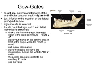 Gow-Gates
•   target site: anteromedial border of the
    mandibular condylar neck – figure 9-46
•   just inferior to the insertion of the lateral
    pterygoid muscle
•   injection site is intraoral
•   locate the intertragic notch and labial
    commisure extraorally
     – draw a line from the tragus/intertragic
       notch to the labial commisure – figure 9-
       47
     – place your thumb on the condyle (just in
       front of the tragus when the mouth is
       open)
     – pull buccal tissue away
     – place the needle inferior to the
       mesiolingual cusp of the MAXILLARY 2nd
       molar
     – the needle penetrates distal to the
       maxillary 2nd molar
     – see the video
 