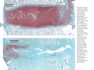 Sagittally oriented
safranin-O–stained
sections of an adult
human lumbar
intervertebral
disk (top) and a
degenerated
intervertebral disk
(bottom). Disk
matrix stains purple
and collagen
blue. In the adult
disk, the peripheral
annulus fibrosus,
containing collagen,
stains blue
(arrowhead).
The inner annulus
fibrosus and nucleus
pulposus,
containing GAGs,
stains purple. The
central portion
of the nucleus
pulposus, where
reticulin, collagen,
and elastin fibers
are located, stains
faintly blue.
The degenerated
disk has lost purple-
staining GAGs
from the nucleus
pulposus and
annulus fibrosus. It
conforms to
Pfirrmann grade IIII
degeneration.
 