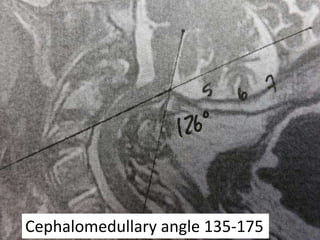 Cephalomedullary angle 135-175
 
