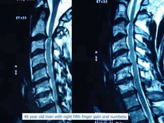 48 year old man with right fifth finger pain and numbess
 