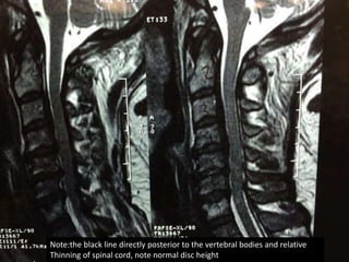 Note:the black line directly posterior to the vertebral bodies and relative
Thinning of spinal cord, note normal disc height
 