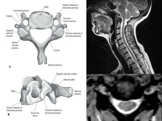 How to read a cervical MRI