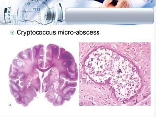 Fungal Incections in Human (Clinical Mycology) | PDF