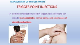 TRIGGER POINT INJECTIONS
 Common medications used in trigger point injections can
include local anesthetic, normal saline, and small doses of
steroid medications.
MANAGEMENT OF TRIGGER POINTS
 