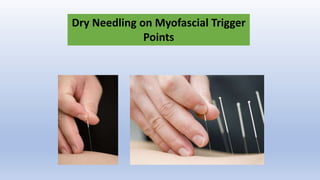 Dry Needling on Myofascial Trigger
Points
 