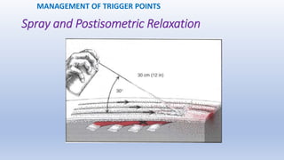 Spray and Postisometric Relaxation
MANAGEMENT OF TRIGGER POINTS
 