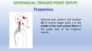 Referred pain pattern and location
(X) of central trigger point 1 in the
middle of the most vertical fibers of
the upper part of the trapezius
muscle.
 