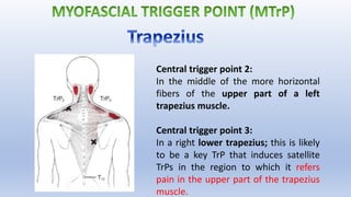 Central trigger point 2:
In the middle of the more horizontal
fibers of the upper part of a left
trapezius muscle.
Central trigger point 3:
In a right lower trapezius; this is likely
to be a key TrP that induces satellite
TrPs in the region to which it refers
pain in the upper part of the trapezius
muscle.
 