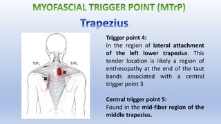 Trigger point 4:
In the region of lateral attachment
of the left lower trapezius. This
tender location is likely a region of
enthesopathy at the end of the taut
bands associated with a central
trigger point 3
Central trigger point 5:
Found in the mid-fiber region of the
middle trapezius.
 