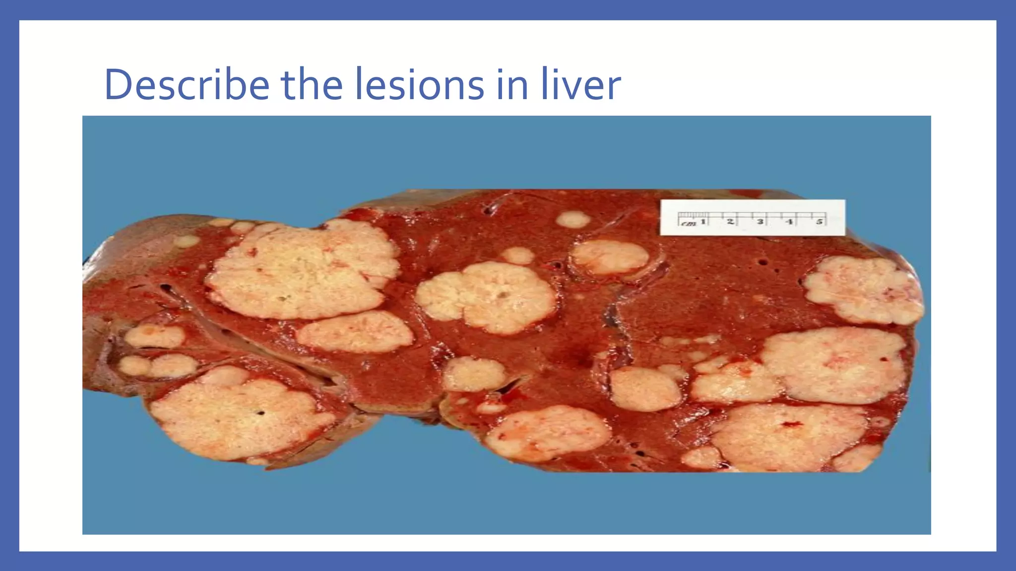 Describe the lesions in liver
 