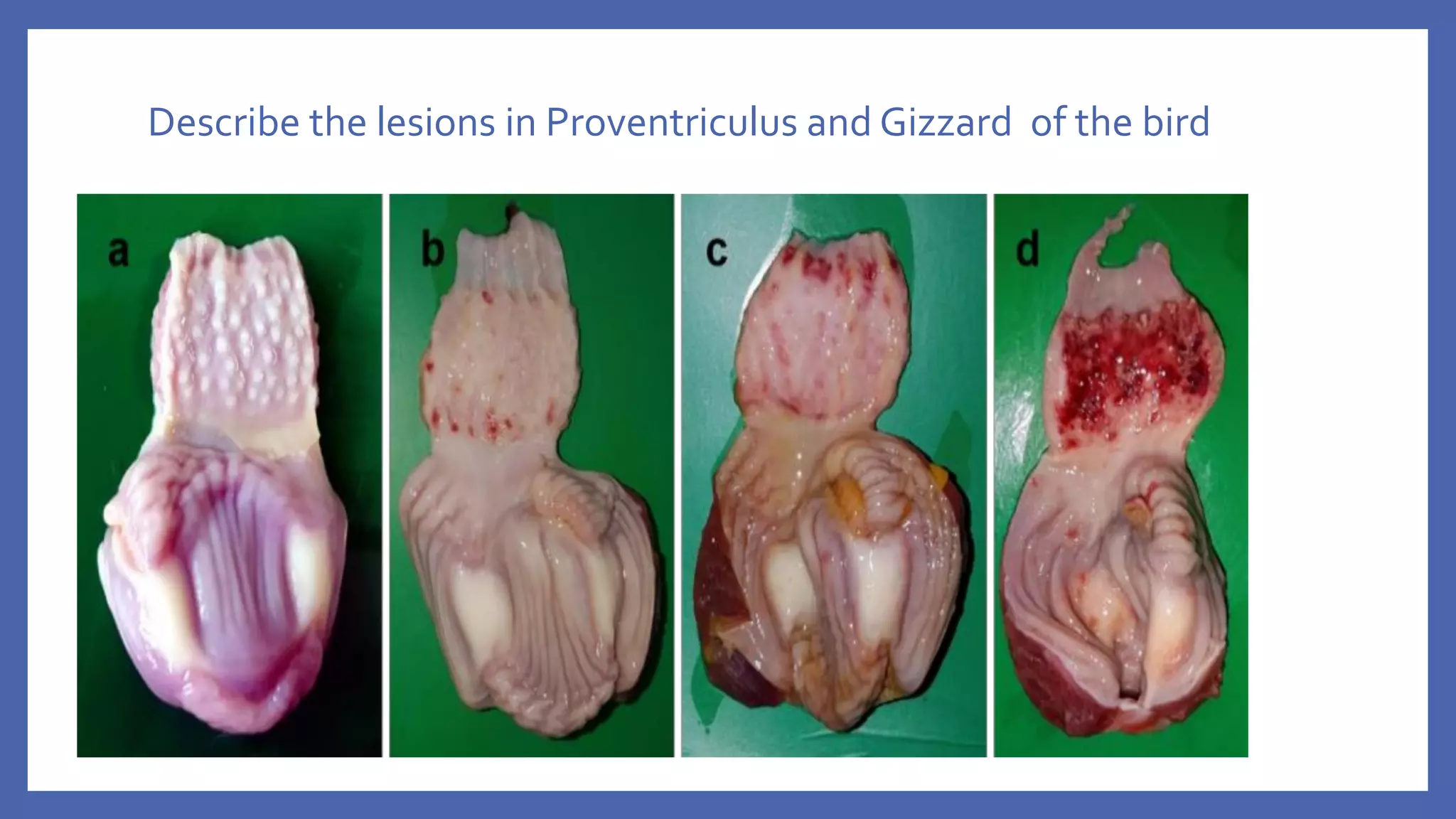 Describe the lesions in Proventriculus and Gizzard of the bird
 